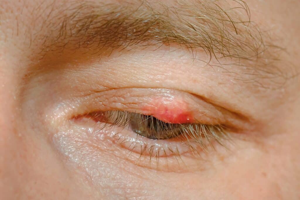 cirugia de chalazion