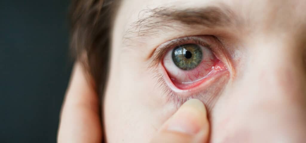 Conoce todos los tipos de conjuntivitis que existen.