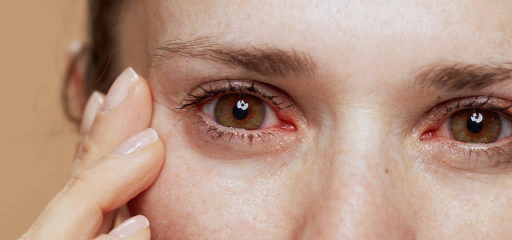 Mujer con infección ocular en ambos ojos.